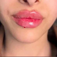 تزریق چربی و‌تخلیه غبغب به روش زاویه سازی|خدمات آرایشگری و زیبایی|اهواز, پادادشهر|دیوار