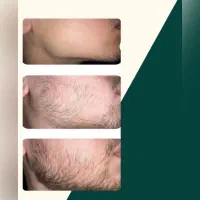 ریشو|آرایشی، بهداشتی، درمانی|گزنک, |دیوار