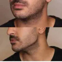 لیزر بوتاکس فیلر زیبایی