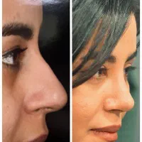 بزگترین هدیه عمل بینی در شیراز 100+میلیون|خدمات آرایشگری و زیبایی|شیراز, ستارخان|دیوار