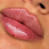 بوتاکس ،جوانساز ،لب روسی ،فول فیس ،فیلر گونه زاویه