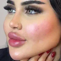 تخفیفات خدمات پوست ، ژل لب ، بوتاکس ، فیلر بادی