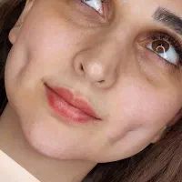 آف 5 روزه تزریق چربی ژل لب چال لپ هیدن آموزش