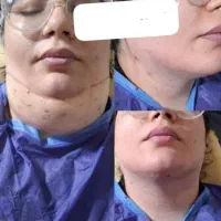 لیپوساکشن چربی جراحی بلفارو لیفت نخ ژل|خدمات آرایشگری و زیبایی|کوهدشت, |دیوار