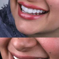 کامپوزیت دندان هالیودی بدون تراش با تخفیف واقعی