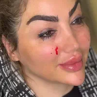 تزریق ژل بوتاکس و چربی شکم پهلو|خدمات آرایشگری و زیبایی|کرمانشاه, |دیوار