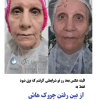 ترمیم و بازسازی انواع ناهنجاری های پوستی|خدمات آرایشگری و زیبایی|شیراز, قصرالدشت|دیوار