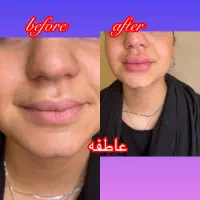 جشنواره فیلروبوتاکس مادلینگ‌صورت باتخفیف ویژه|خدمات آرایشگری و زیبایی|تهران, کوهک|دیوار