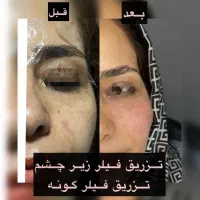 تزریق وآموزش فیلر و بوتاکس|خدمات آموزشی|فردیس, فردیس|دیوار