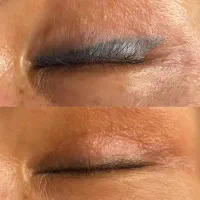 پاک کردن تتو و رفع تیرگی و کک و مک در شهرری