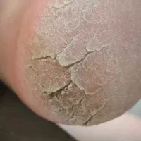 خدمات پدیکور