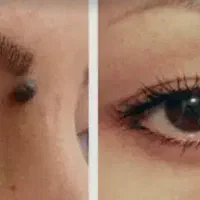 برداشتن خال وزیگل تناسلی با لیزر