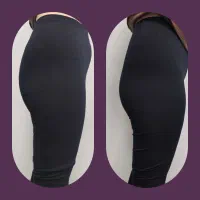 تزریق فیلربدن(بیکینی،باسن،هیپ دیپ) با تخفیف