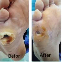 تزریقات سرم سوند پانسمان زخم بستر پای دیابتی|خدمات آرایشگری و زیبایی|تبریز, |دیوار