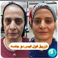 تخفیفات ۵۵٪ دکتر ملائی ،مزو بوتاکس فیلر ژل لب روسی|خدمات آرایشگری و زیبایی|مشهد, سرافرازان|دیوار
