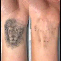 ریموتتو ابرو و بدن با پیشرفته ترین دستگاه تضمینی|خدمات آرایشگری و زیبایی|اهواز, کیانپارس |دیوار