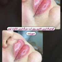 خدمات تزریقات فیلر(ژل)وبوتاکس باپترووآزاد|خدمات آرایشگری و زیبایی|بندر ماهشهر, |دیوار