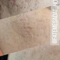 حذف دائمی کک و مک|خدمات آرایشگری و زیبایی|تربت جام, المهدی|دیوار