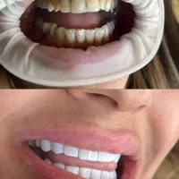 آف ویژه خدمات تخصصی کامپوزیت دندان|خدمات آرایشگری و زیبایی|شاهین‌شهر, فردوسی|دیوار