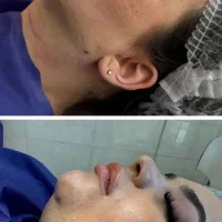 بوتاکس،تزریق فیلر صورت و بادی،ساکشن چربی و تزریق