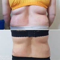 لاغری با کویتیشن آراف در کلینیک تخصصی الماس