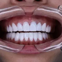 آموزش کامپوزیت دندان