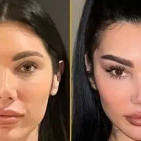 پزشک جراحی بلفا غبغب نخ لیفت کلاژن آنزیم ژل فیلر|خدمات آرایشگری و زیبایی|کرج, گوهردشت|دیوار