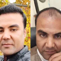 کاشت مو، ابرو، ریش توسط تکنسین15سال تجربه|خدمات آرایشگری و زیبایی|تهران, صادقیه|دیوار