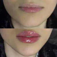 مزوژل فیلر بینی ژل لب لیفت صورت بوتاکس آنزیم گونه