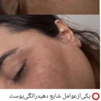 پاکسازی تخصصی پوست با دستگاه|خدمات آرایشگری و زیبایی|لاهیجان, امیرشهید|دیوار