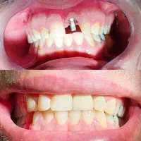دندانپزشکی ایمپلنت لمینت اقساط بلند مدت
