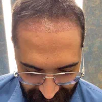 کاشت مو، ریش، ابرو|خدمات آرایشگری و زیبایی|تهران, الهیه|دیوار