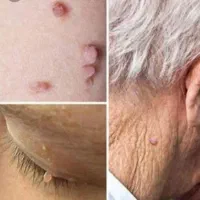 درمان بیماری های مقاربتی و hpv