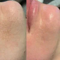 فیشال و پاکسازی تخصصی پوست، اف ۲۰درصد|خدمات آرایشگری و زیبایی|اندیمشک, |دیوار