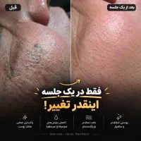 پاکسازی و فیشیال تخصصی آقایان شروع قیمت از ۶۵۰