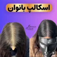 شبیه سازی فولیکول مو smp اس کالپ|خدمات آرایشگری و زیبایی|دوگنبدان, |دیوار