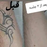 لیزر ریمووتتو(پاک کردن) ریموتاتوابرو.بدن کربنتراپی
