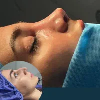 آف ویژه عمل زیبایی بینی ۱۹ میلیون|خدمات آرایشگری و زیبایی|شوش, |دیوار