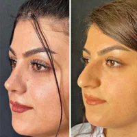 جراحی بینی با ۲۴ تومن فقط روز ۳۱ مرداد|خدمات آرایشگری و زیبایی|تهران, نظامی گنجوی (توانیر)|دیوار