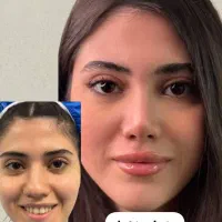عمل جراحی بینی در تهران /جشنواره