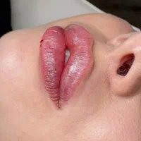 تزریق فیلرحرفه ای