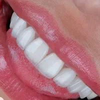 کامپوزیت دندان لمینت روکش دندانپزشکی نامبروان