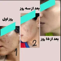 پک ضد جوش|آرایشی، بهداشتی، درمانی|شیراز, آزادگان|دیوار