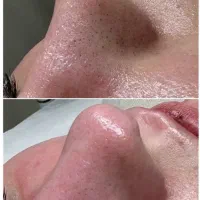 تخفیف یلدایی پاکسازی پوست فقط ۵۰۰تومن|خدمات آرایشگری و زیبایی|محمدیه-قزوین, |دیوار