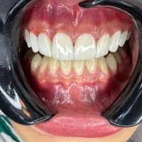 کامپوزیت و لمینیت دندان