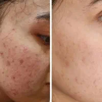 حذف لک و منافذ باز و جای جوش/زیر نظر متخصص پوست|خدمات آرایشگری و زیبایی|مشهد, الهیه|دیوار