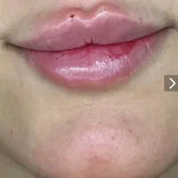 بوتاکس و ژل  و مزو صورت و مو