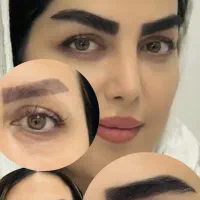 کاشت مو و ابرو