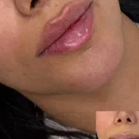 جشنواره ژل،بوتاکس،تزریق چربی،اندولیفت تضمینی