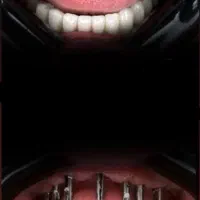 مرکز تخصصی دندانپزشکی ایمپلنت آلمانی(اقساط ۱۲ماهه)|خدمات آرایشگری و زیبایی|تبریز, |دیوار